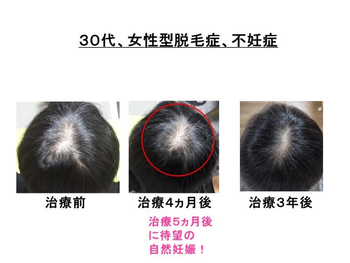 円形脱毛症　病院